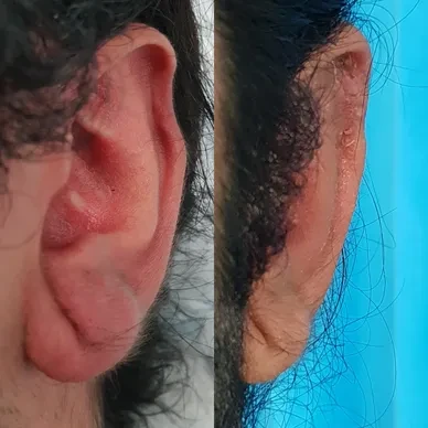 Helical rim reconstruction — before and after result