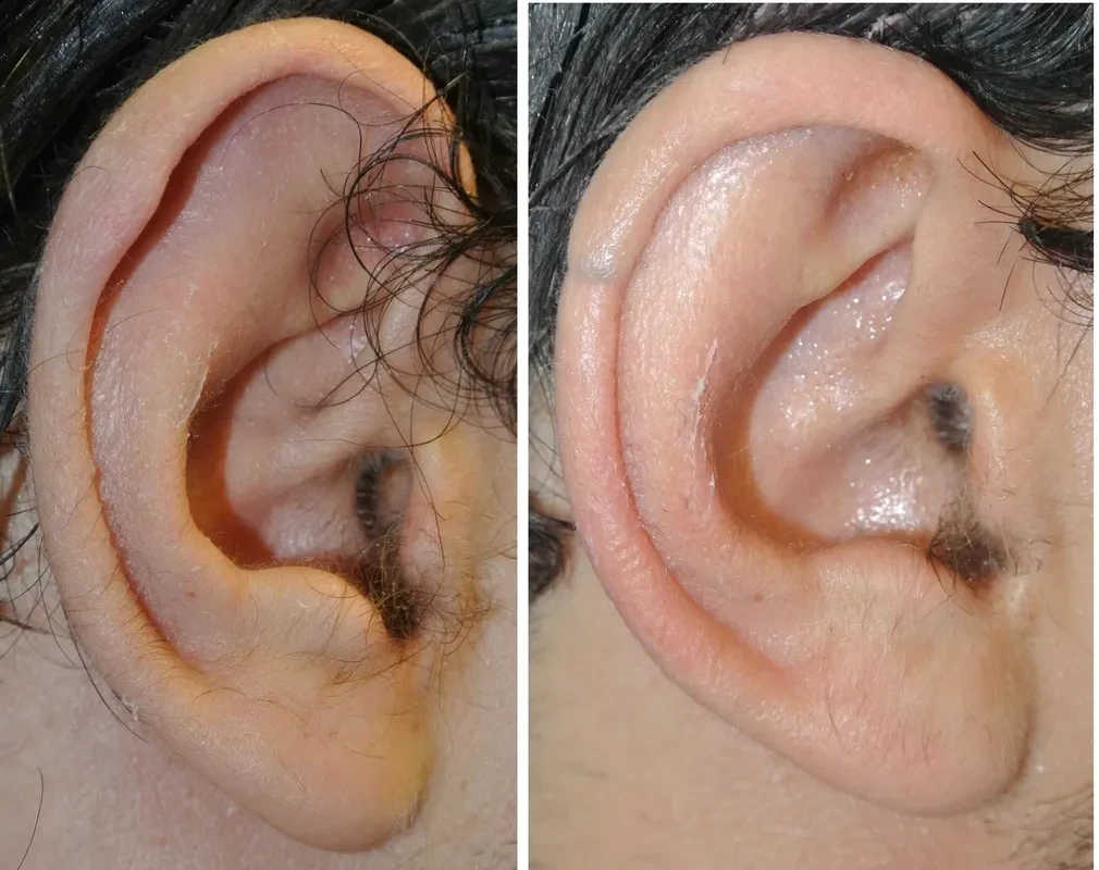Ear reduction — before and after, helical rim reduction result