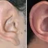 Ear reduction — before and after, close-up comparison