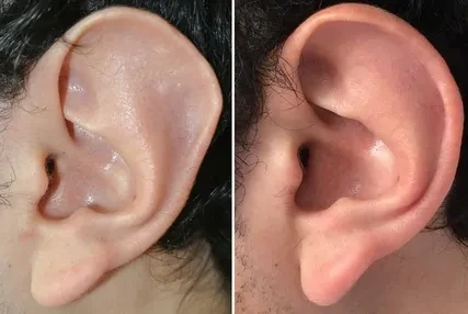 Ear reduction — before and after, surgical result