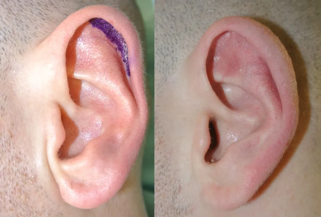 Ear reduction — surgical marking and post-operative result