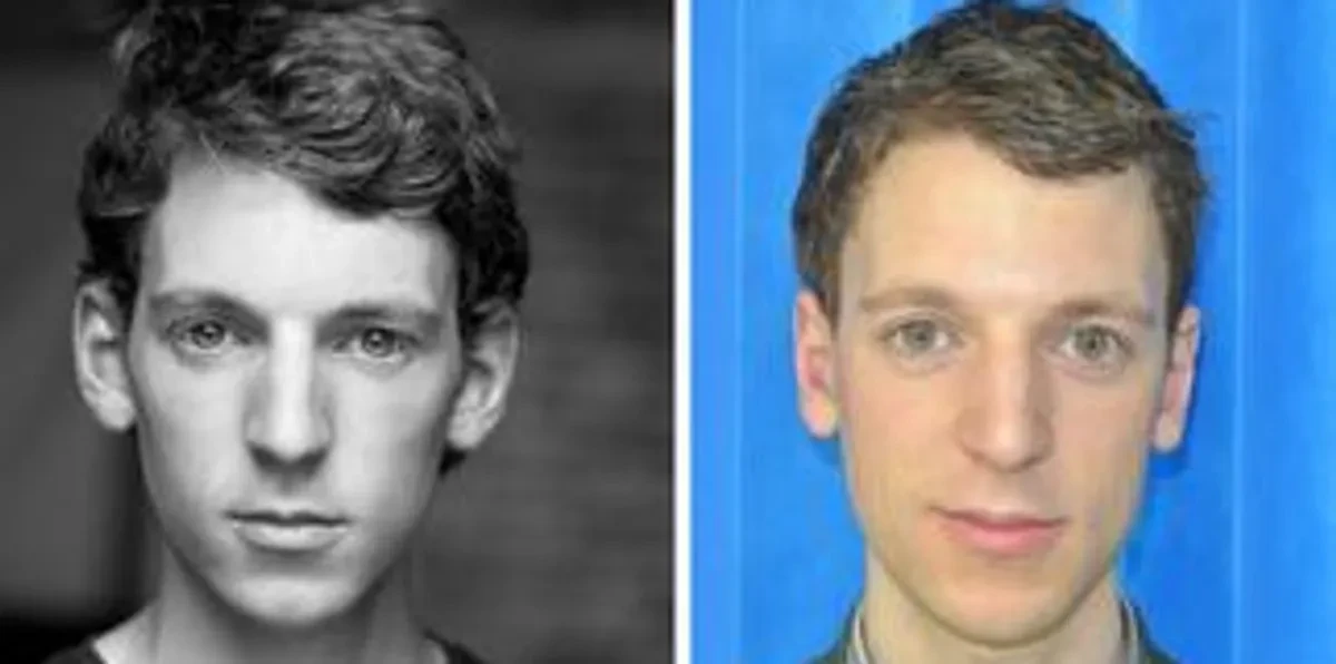 EarStitch patient — before and after, adult male ear correction