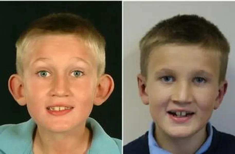 EarStitch patient — before and after, child ear correction
